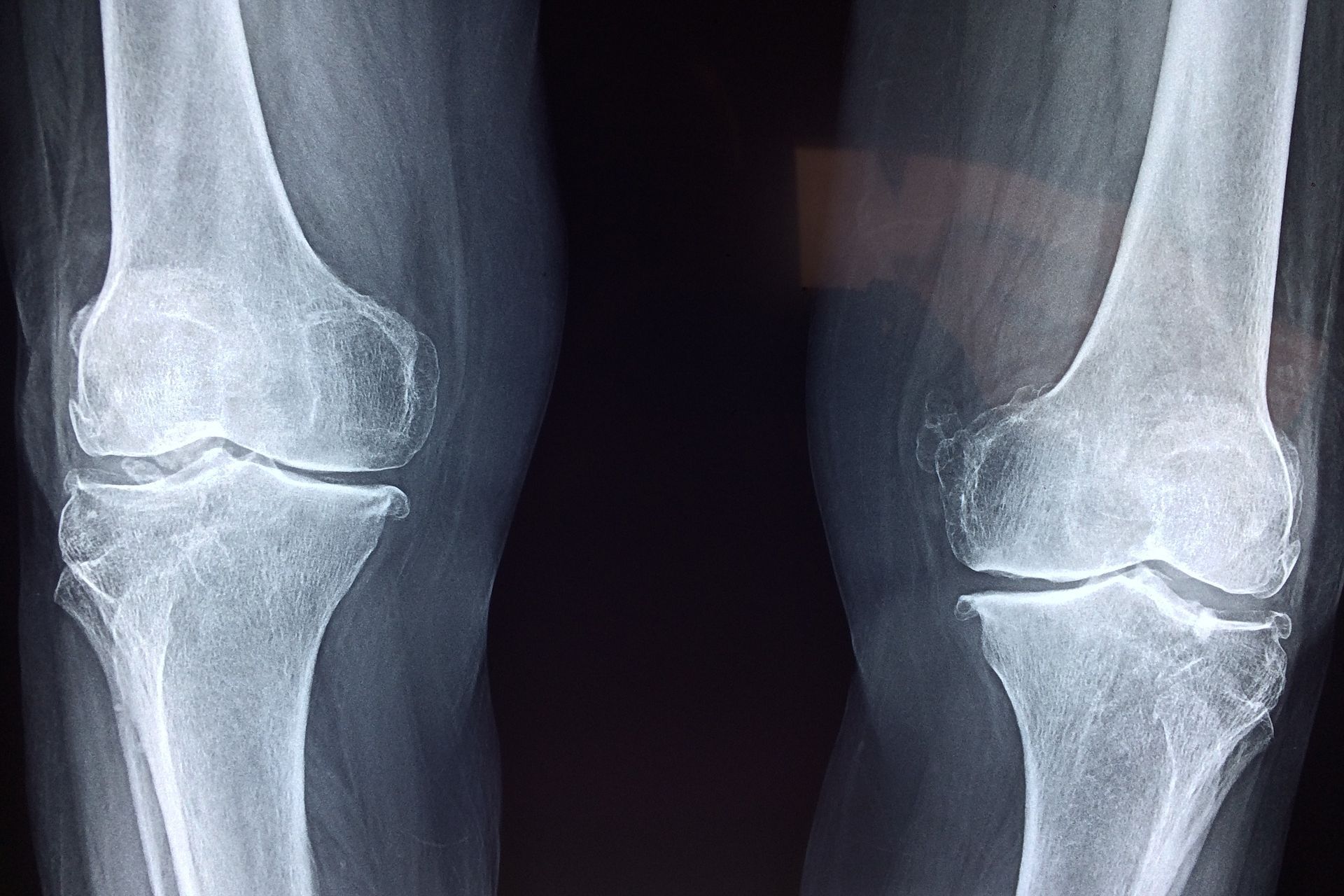 Ginocchia umane sottoposte a esami radiologici