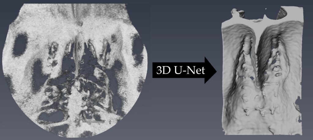 Le scansioni TC producono da 3.000 a 65.000 livelli di grigio, ma l'occhio umano può distinguere meno di 20 gradazioni e la segmentazione manuale di grandi volumi 3D è difficile e richiede tempo. Gli algoritmi di intelligenza artificiale sviluppati da Leucadia identificano bordi, confini e fori per rivelare dove si verificano le aperture e quanto sono grandi, utilizzando una TAC a fascio conico a basso dosaggio