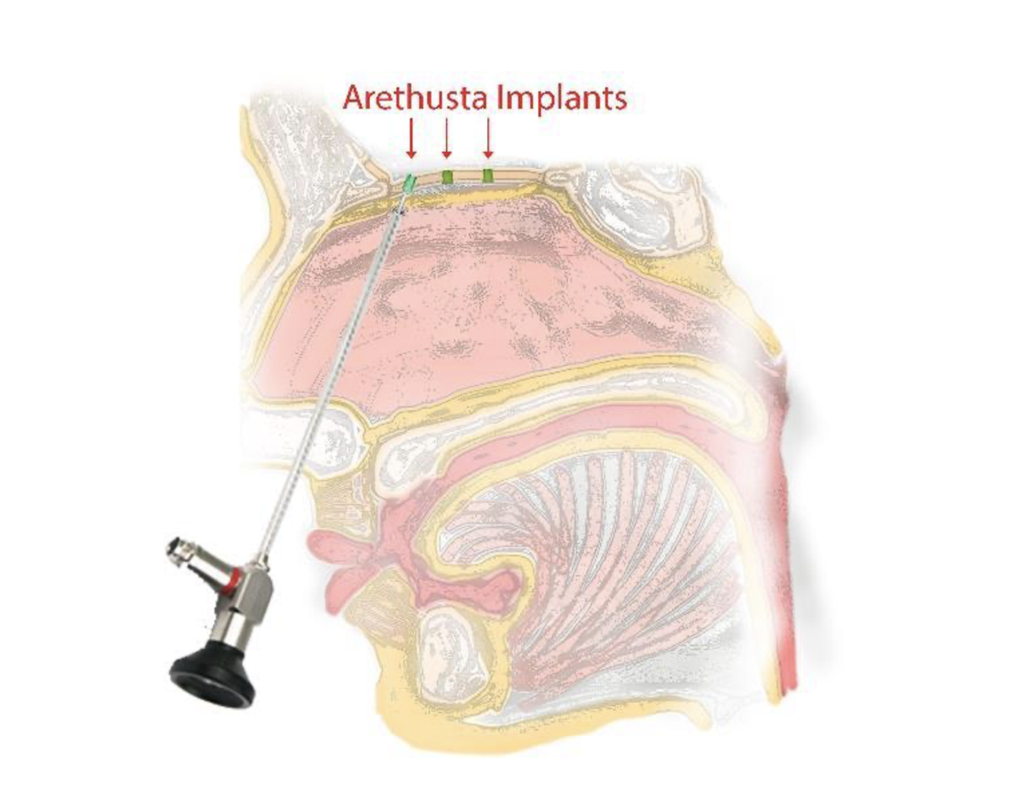 L'impianto Arethusta congegnato da Leucadia Therapeutics per favorire il "bran drain" e prevenire il morbo di Alzheimer