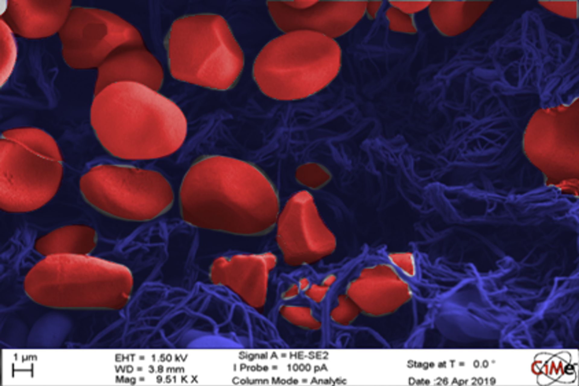 Al centro di un coagulo di sangue con il microscopio elettronico a scansione è possibile visualizzare chiaramente i globuli rossi con un diametro di pochi micrometri (Foto: EMPA)