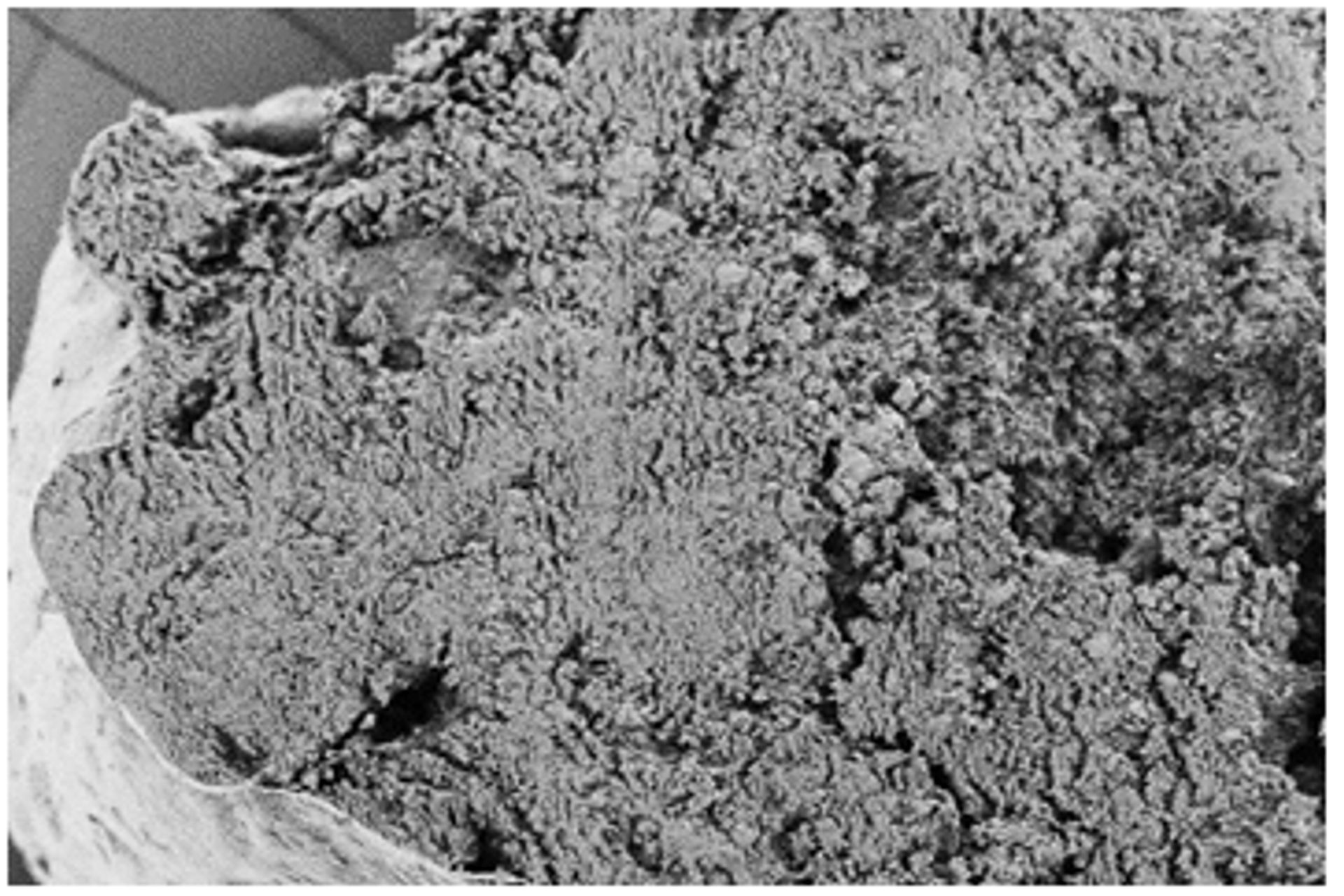 Un trombo può anche calcificare: al microscopio elettronico a scansione, il coagulo di sangue appare omogeneo (immagine di colore grigio). Soltanto uno speciale metodo radiografico in laboratorio, la spettroscopia a raggi X a dispersione di energia, mostra quanto il trombo sia gravemente calcificato (immagine di colore viola) (Foto: EMPA)