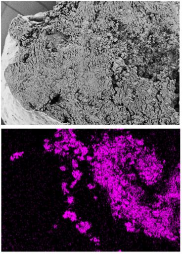 Un trombo può anche calcificare: al microscopio elettronico a scansione, il coagulo di sangue appare omogeneo (immagine di colore grigio). Soltanto uno speciale metodo radiografico in laboratorio, la spettroscopia a raggi X a dispersione di energia, mostra quanto il trombo sia gravemente calcificato (immagine di colore viola) (Foto: EMPA)