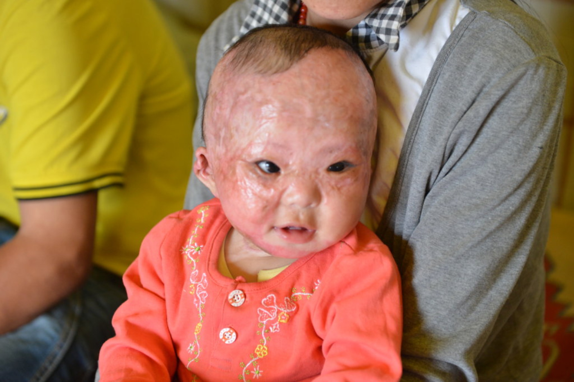 Un bambino vittima di ustioni al volto in Mongolia, per il quale l’associazione Global Giving ha raccolto fondi su Internet (Foto: globalgiving.org)