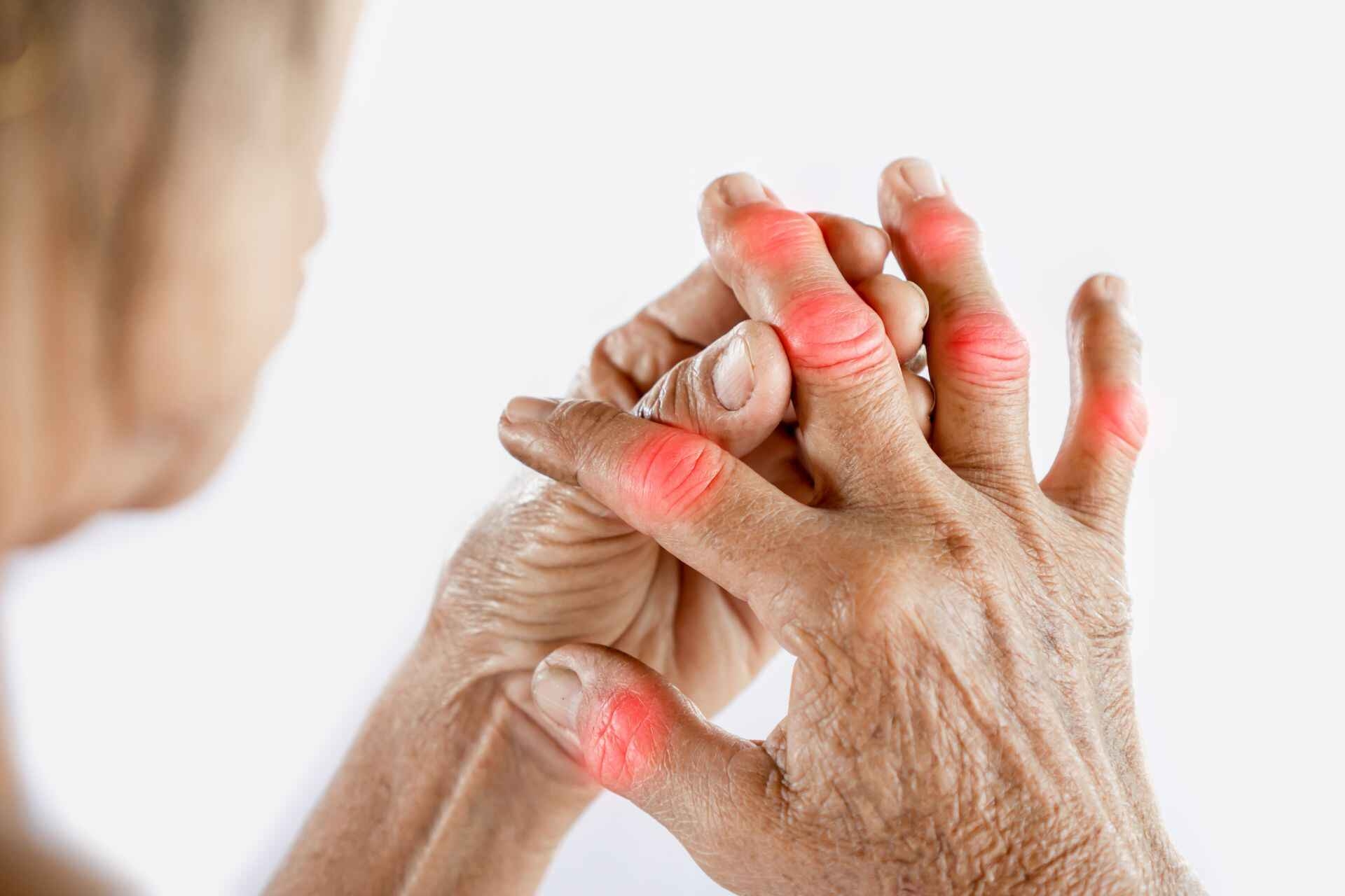 L’inizio dell’Artrite è sempre riconducibile ad uno stato infiammatorio