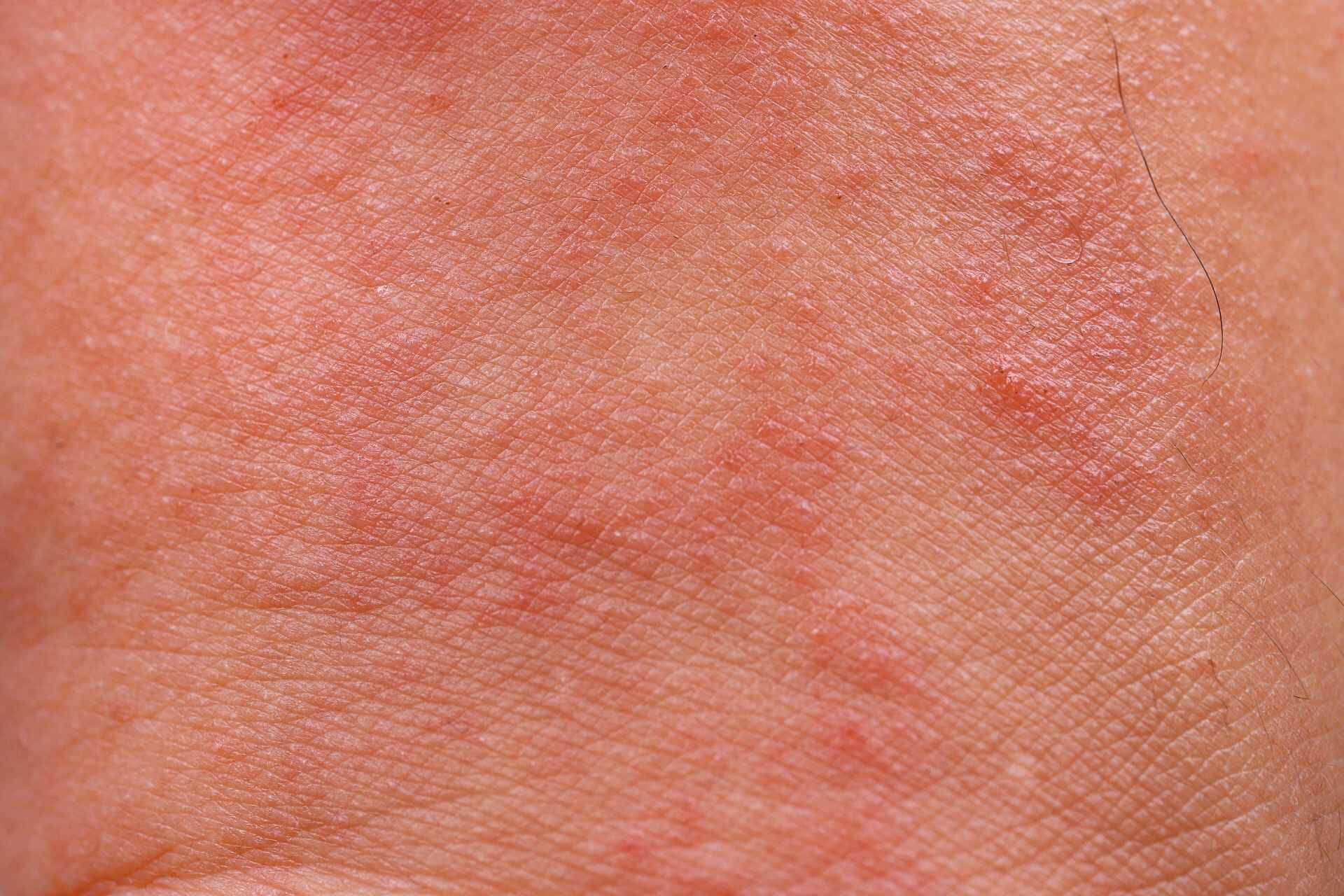 Dermatite: rimedi e prevenzione secondo un approccio innovativo