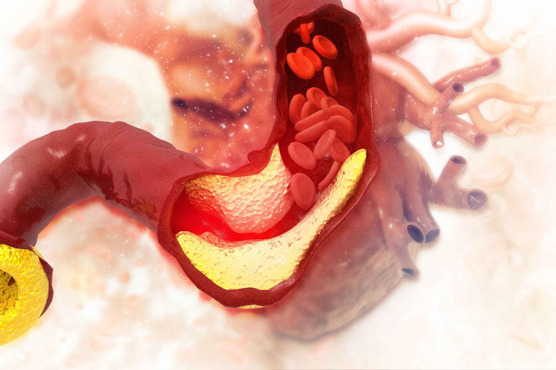 Colesterolo: il colesterolo è un grasso denso che si lega ad alcune proteine e finisce nel sangue