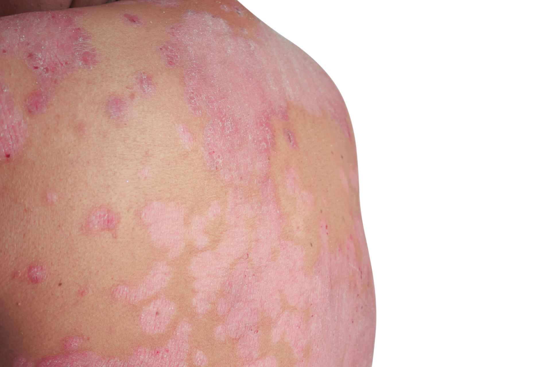 Psoriasi: le placche psoriasiche possono estendersi anche a tutto il corpo