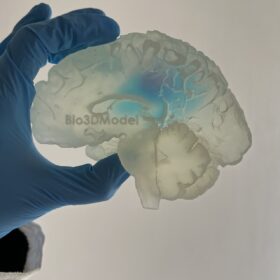 Così è stato riprodotto in 3D un cervello umano affetto da tumore