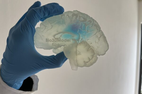 Così è stato riprodotto in 3D un cervello umano affetto da tumore