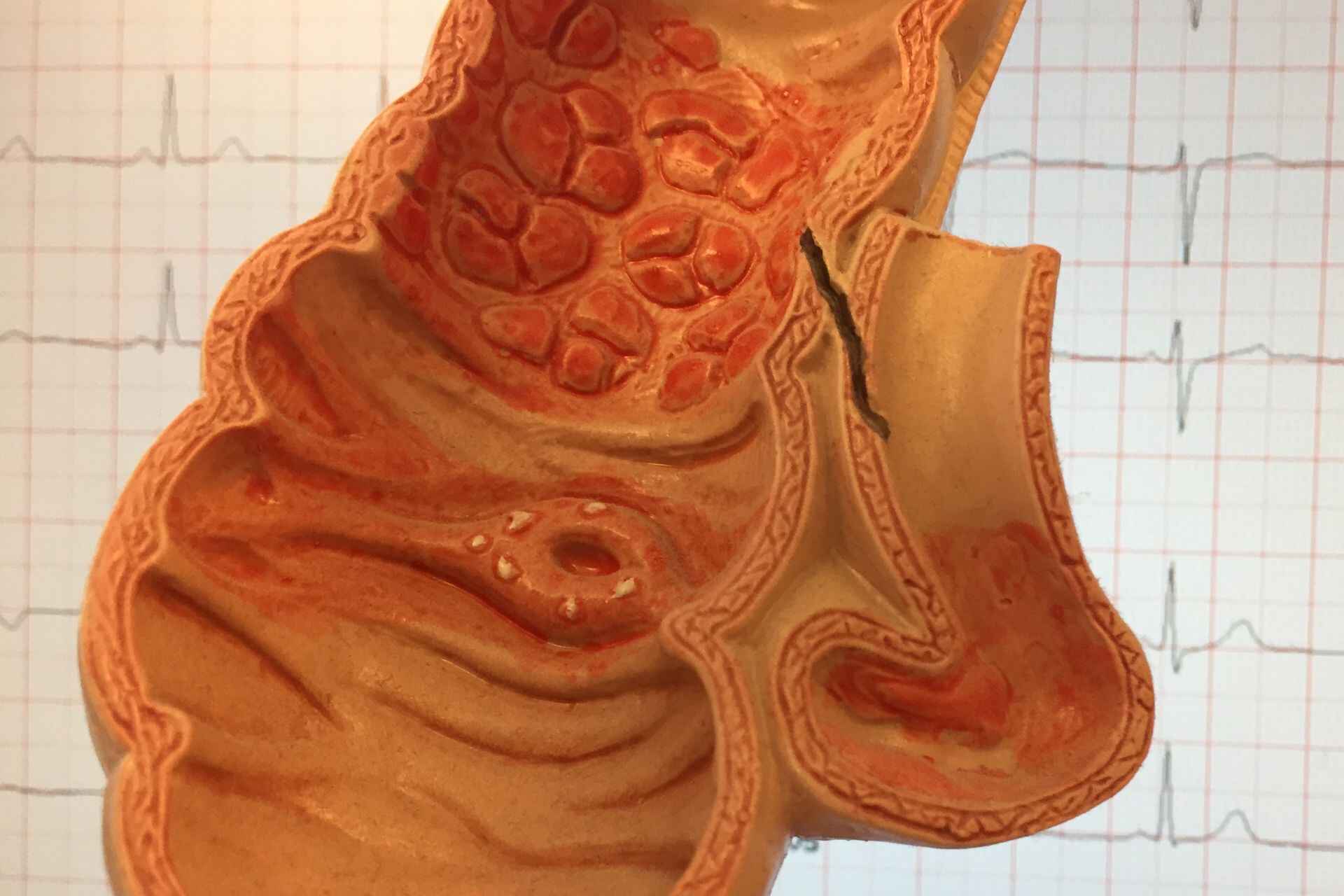 Il Morbo di Crohn: cause, sintomi e alcuni rimedi innovativi...