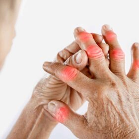Artrite, Artrosi e dolori articolari: combatterli con il cibo giusto