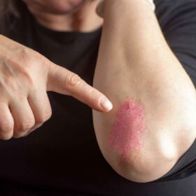 Psoriasi: cause, sintomi, cure e trattamenti in un’ottica innovativa