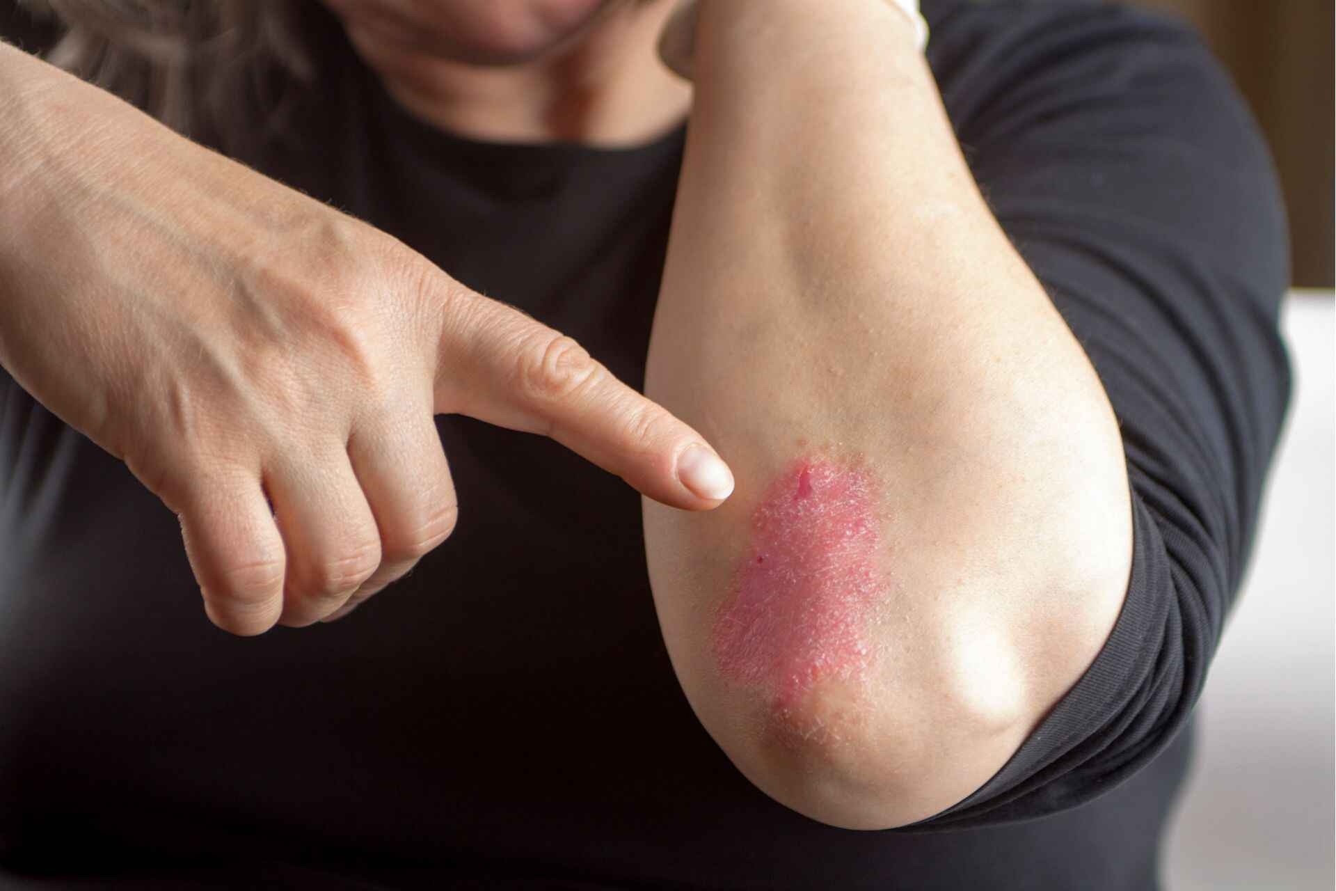 Psoriasi: cause, sintomi, cure e trattamenti in un’ottica innovativa