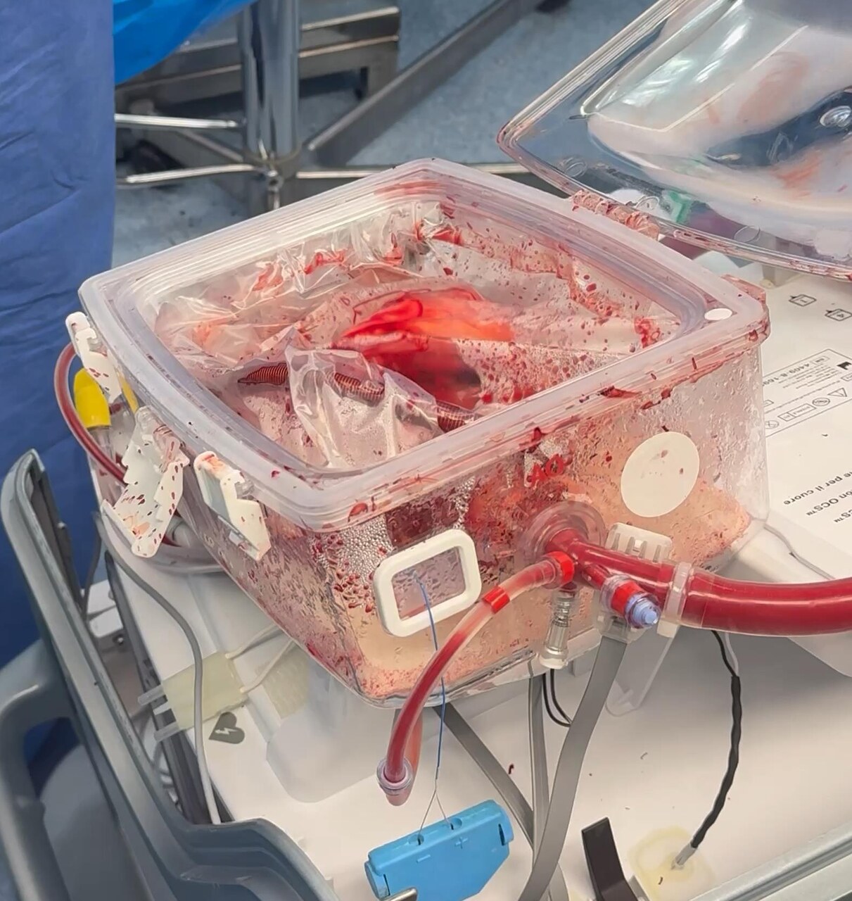 Trapianto a cuore battente: riuscito a Padova il primo intervento di questo tipo al mondo