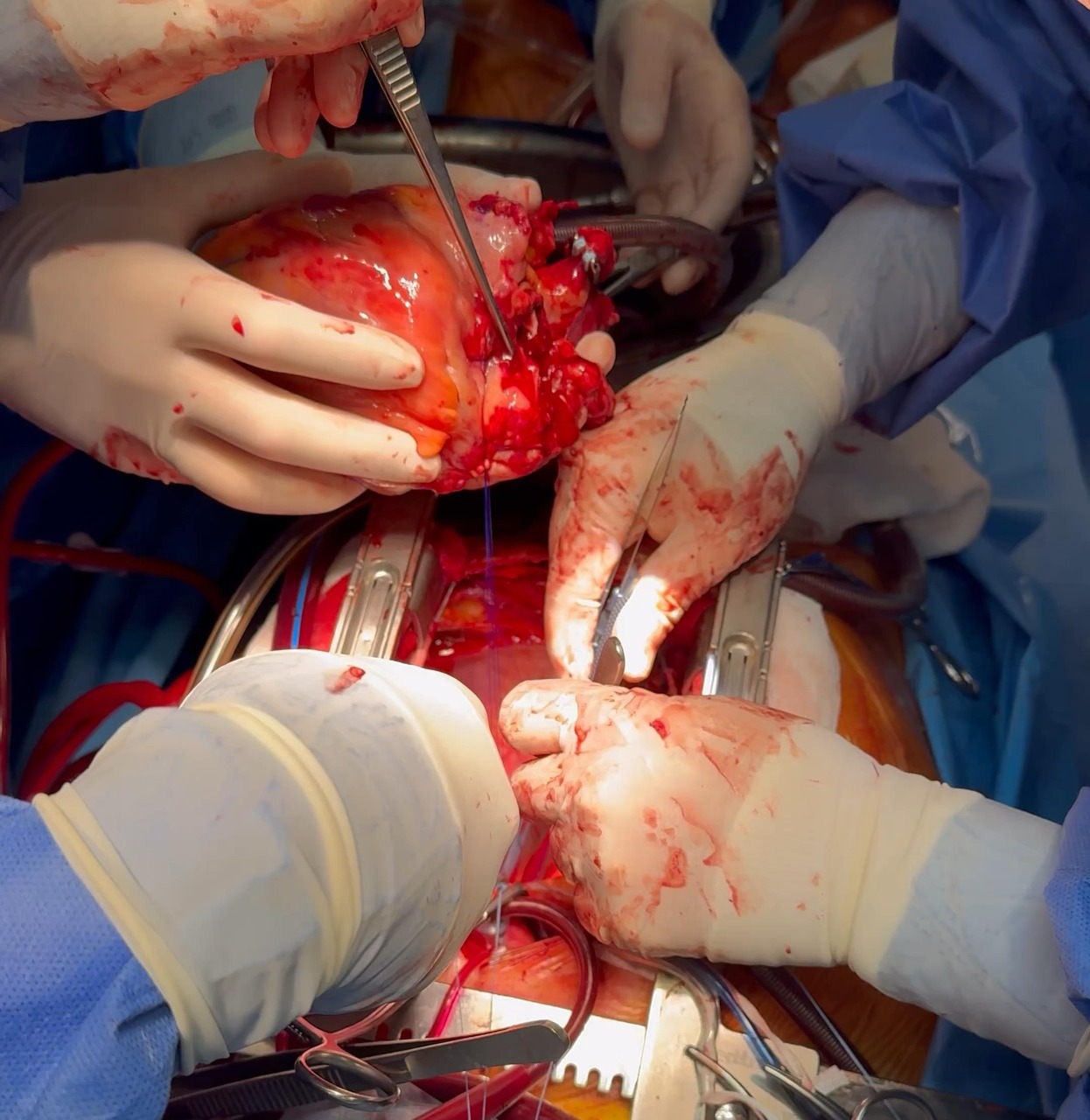 Trapianto a cuore battente: una delle fasi dell'intervento di Padova