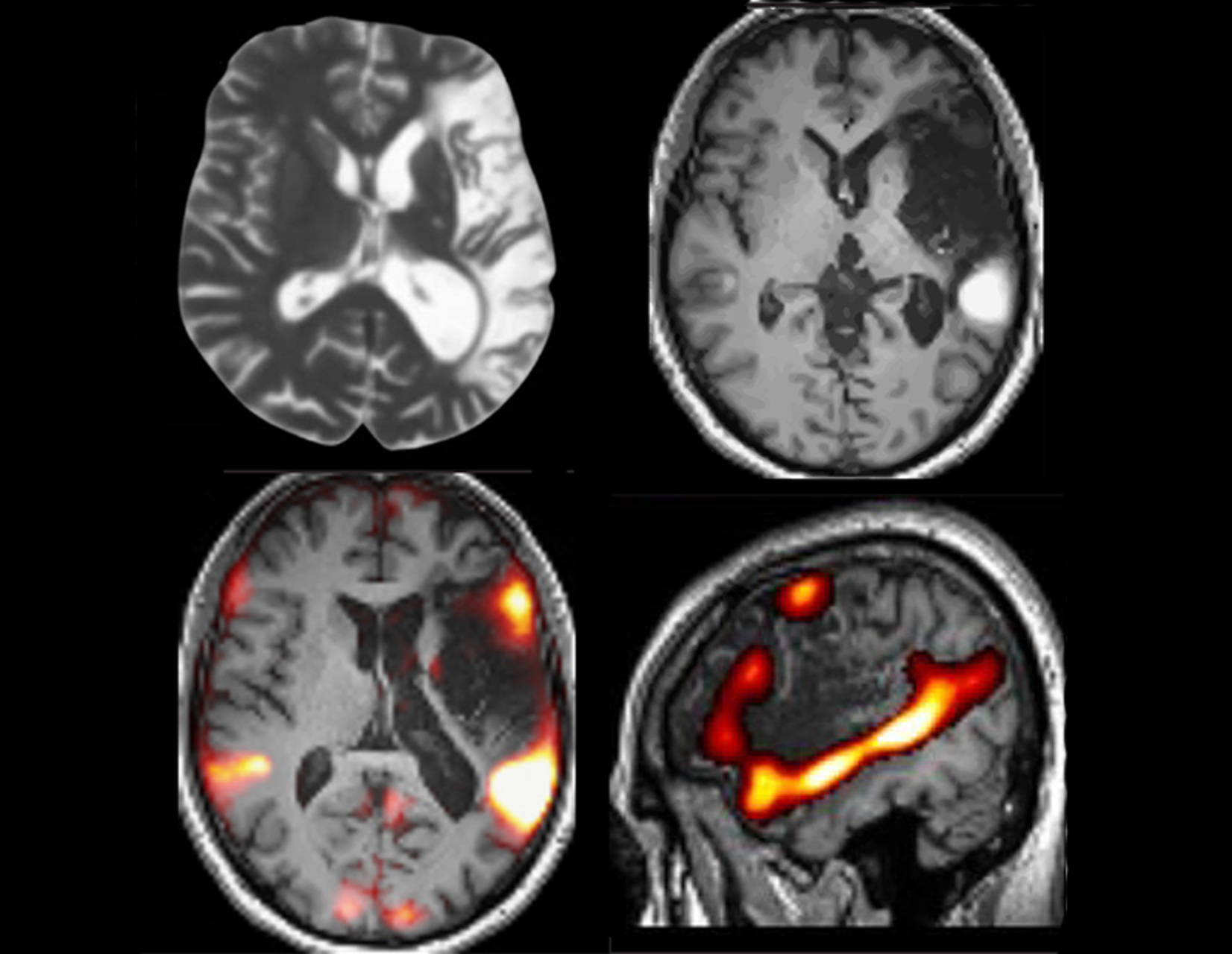 Logica e linguaggio: ricerca neuroscientifica sul funzionamento del cervello umano, con immagini di risonanza magnetica, attività cerebrale e studio dei processi cognitivi legati al pensiero